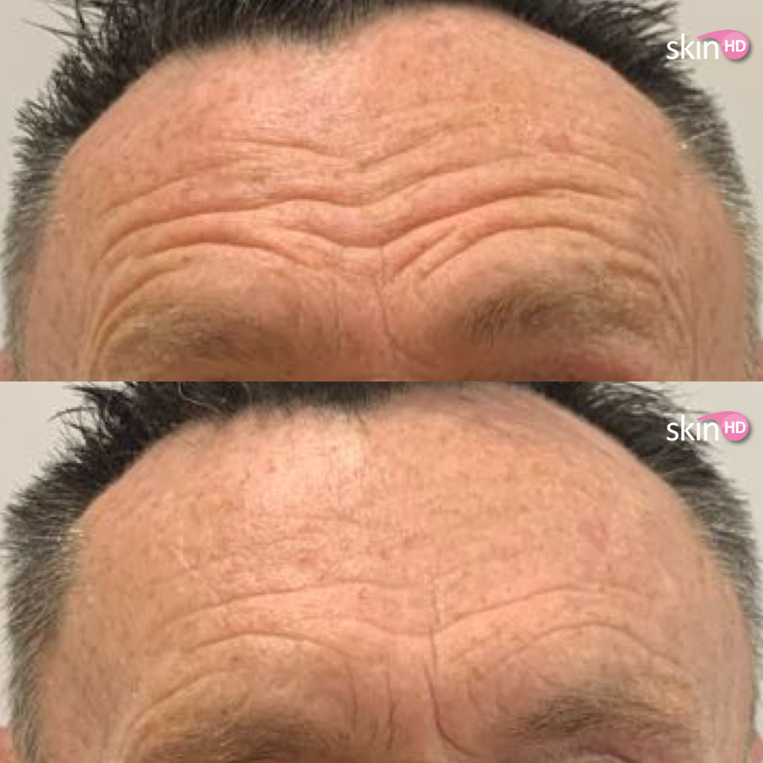 MH botox before & after