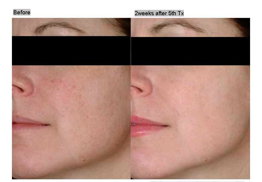 BA 2D facial 3