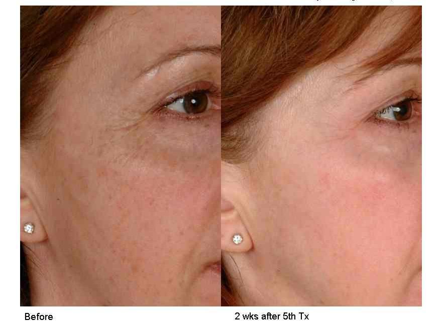 BA 2D facial 1