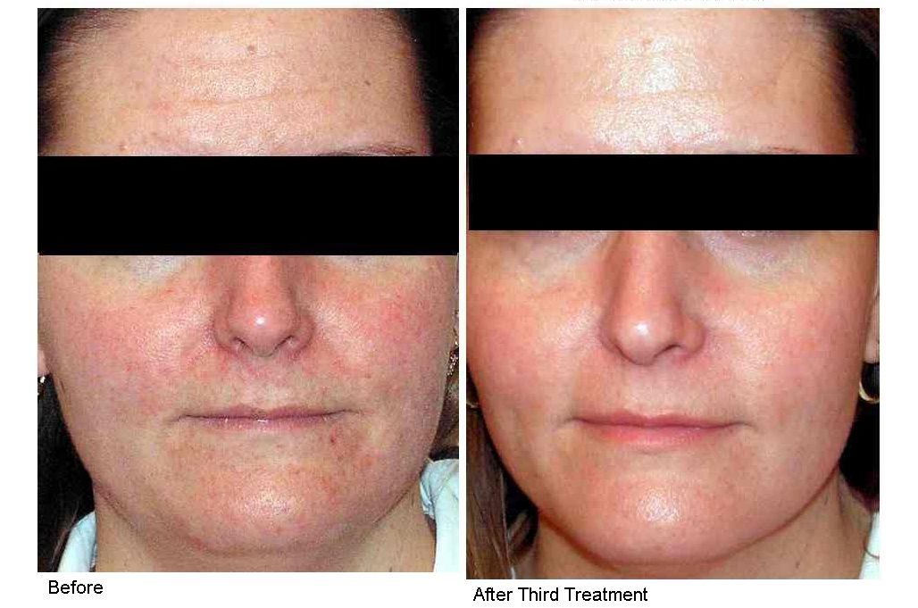 BA 2D facial 2