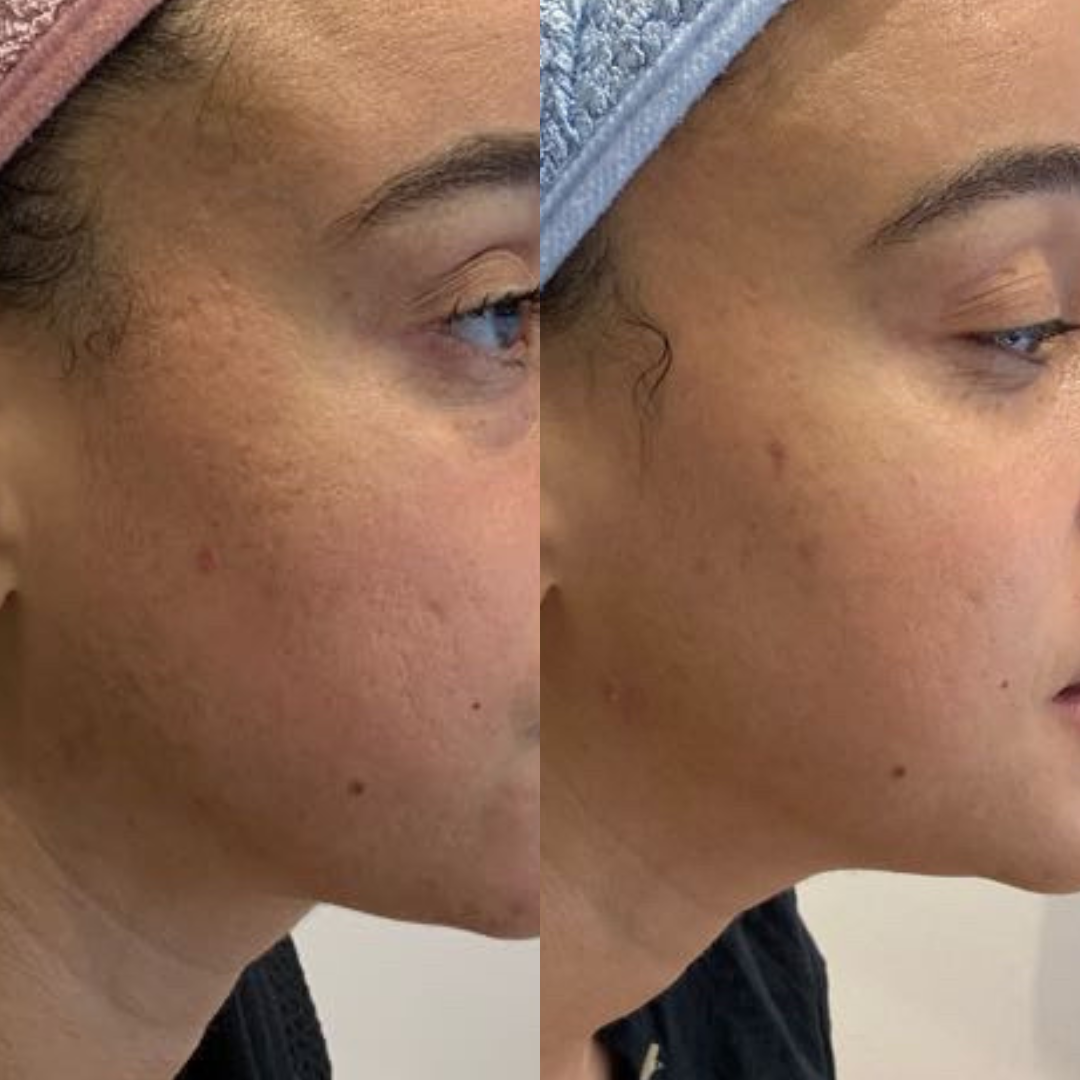 microneedling before and after