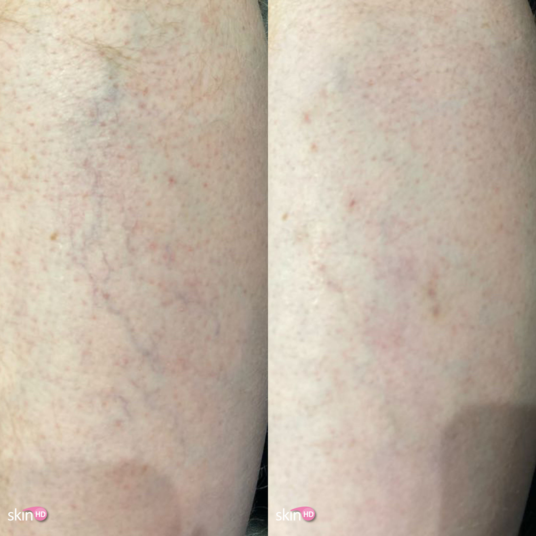 vein removal