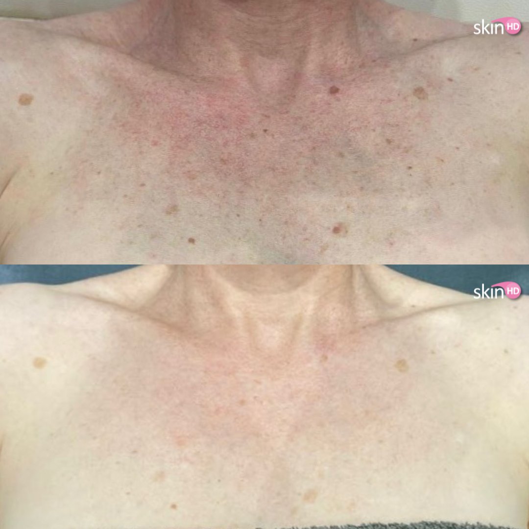 eq ipl before & after